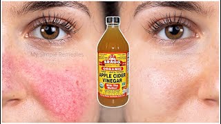 How To Remove Eczema, Blemishes, Acne Marks & Age Spots (100% Effective) Tested Proven Way