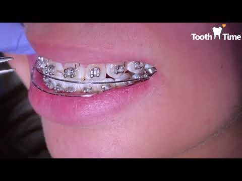 Braces Check ups - Finishing wire - 1 year 4 months with braces Tooth Time New Braunfels