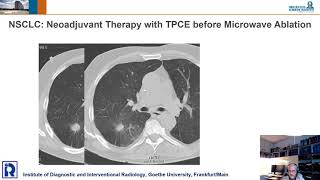 Lung & Intraarterial Approach - Thomas. J. Vogl