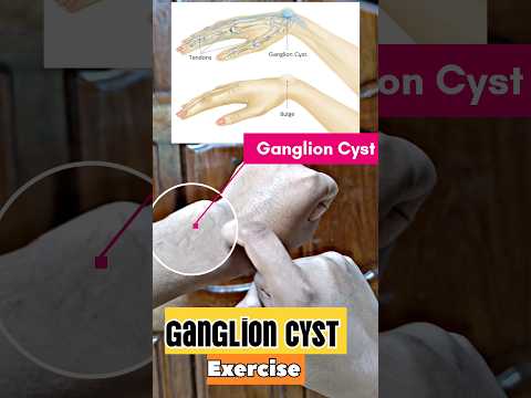 Ganglion Cyst Exercise #physiotherapy #exercise #help #treatment #wristpain