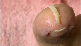 Ep_8838 Ingrown toenail removal 👣 ใส่ยา กั้นสำลี ทำได้ง่าย ๆ แบบนี้ 😅 (clip from Thailand)
