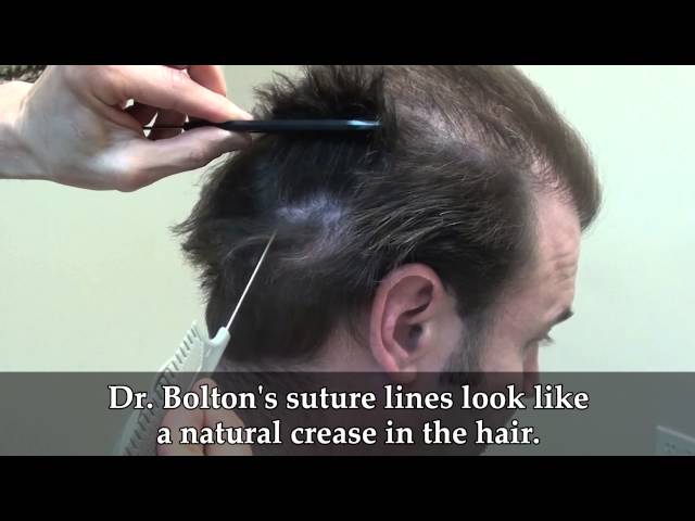 Marc's Scar