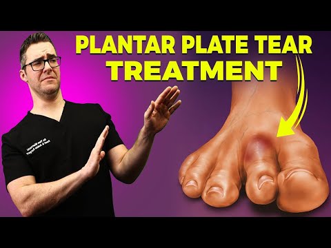 Heel Spurs Plantar Fasciitis BEST Home Treatment 2022