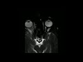 Eye Rubbing MRI 1