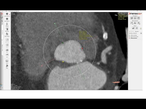 Sizing the Aortic Valve Annulus   3Mensio