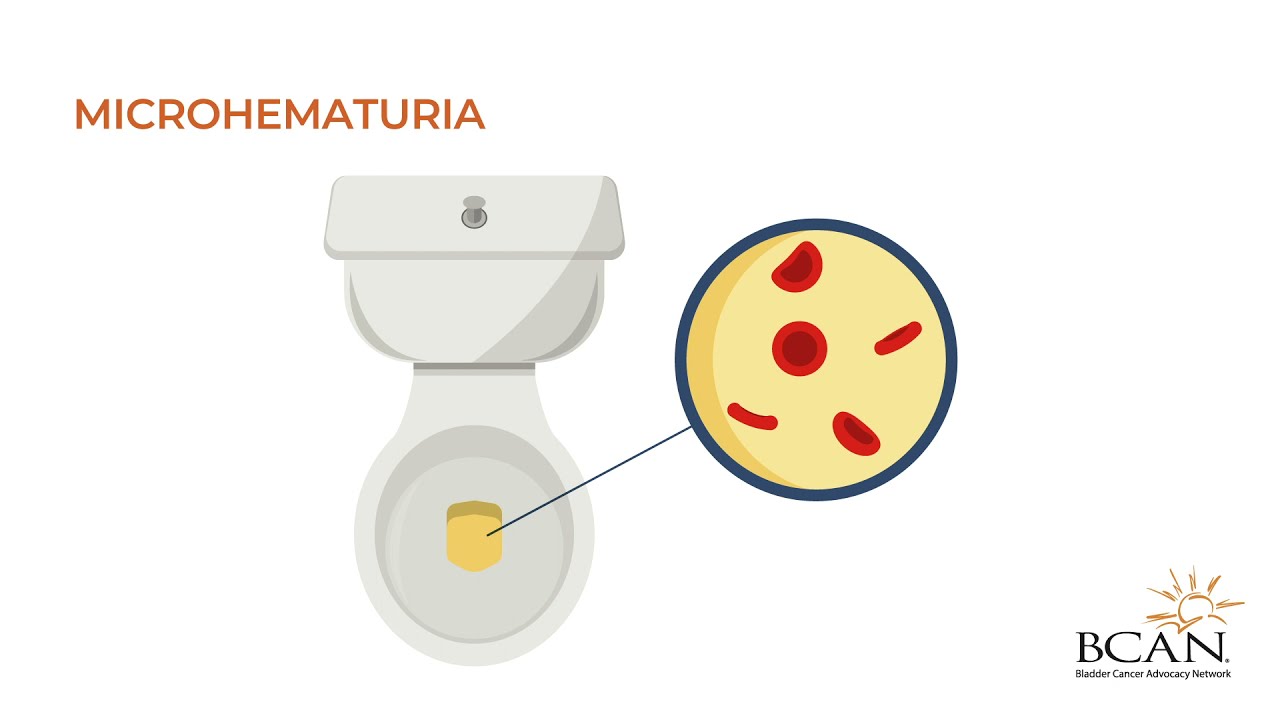 What is hematuria?