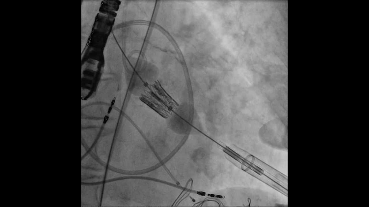 TAVR-Transcatheter Aortic Valve Replacement: Transapical Deployment