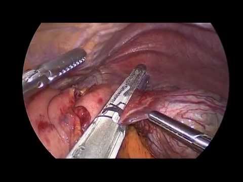 Laparoscopic Gastric GIST Resection