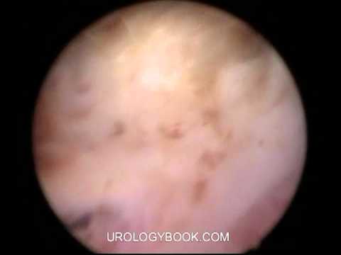 Holmium Laser Enucleation Of Prostate 4/9