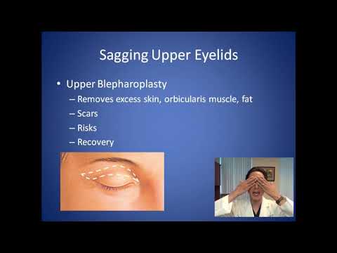 Wie kann ich herabhängende Oberlider korrigieren? - Beratung zur Oberlidstraffung - Dr. Anthony Youn