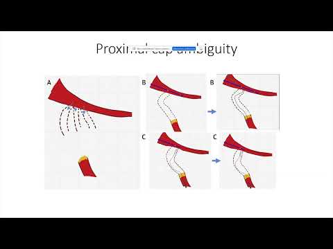 Global Chronic Total Occlusion Crossing Algorithm: JACC State-of-the-Art Review