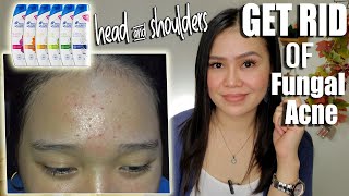 How to GET RID of FUNGAL ACNE with HEAD & SHOULDERS | UPDATED