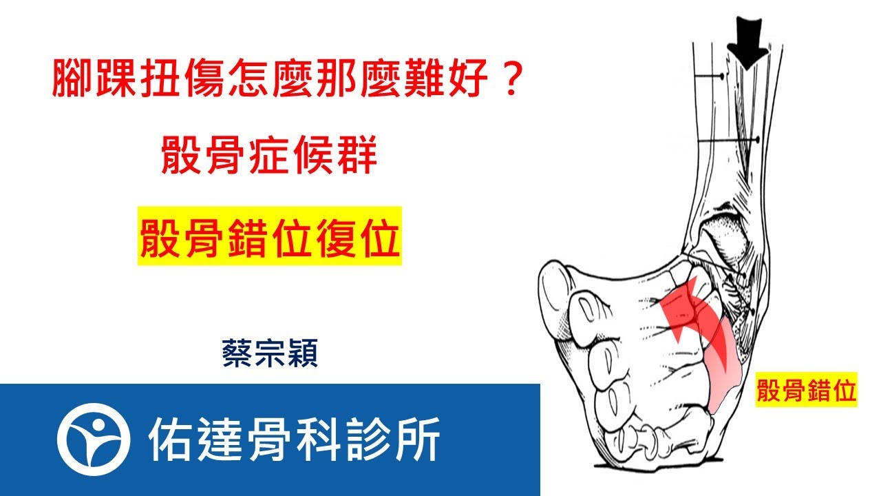 【骰骨錯位復位】【佑達骨科】【蔡宗穎醫師】骰骨症候群、骰骨錯位症候群、骰骨脫位錯位、骰骨卡住、Cuboid syndrome、Cuboid subluxation、Locked cuboid。 - AI健康醫療影片