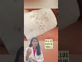 Blackhead Removal Nose Blackheads Blackheads Pore Strips