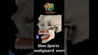 How mouth guard works