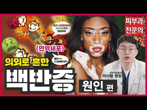 백반증은 왜 생기는 걸까? 100명중 1명은 있다는 꽤 흔한 백반증의 원인과 진단방법! - 백반증 1편