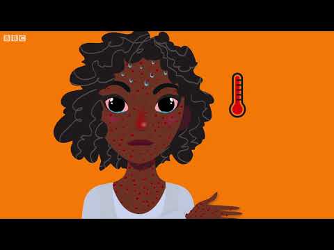 What is Measles? - BBC What's New