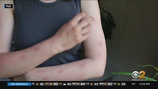 State disaster emergency declared as monkeypox cases soar in New York