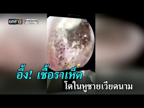 คลิกเพื่อดูคลิปวิดีโอ