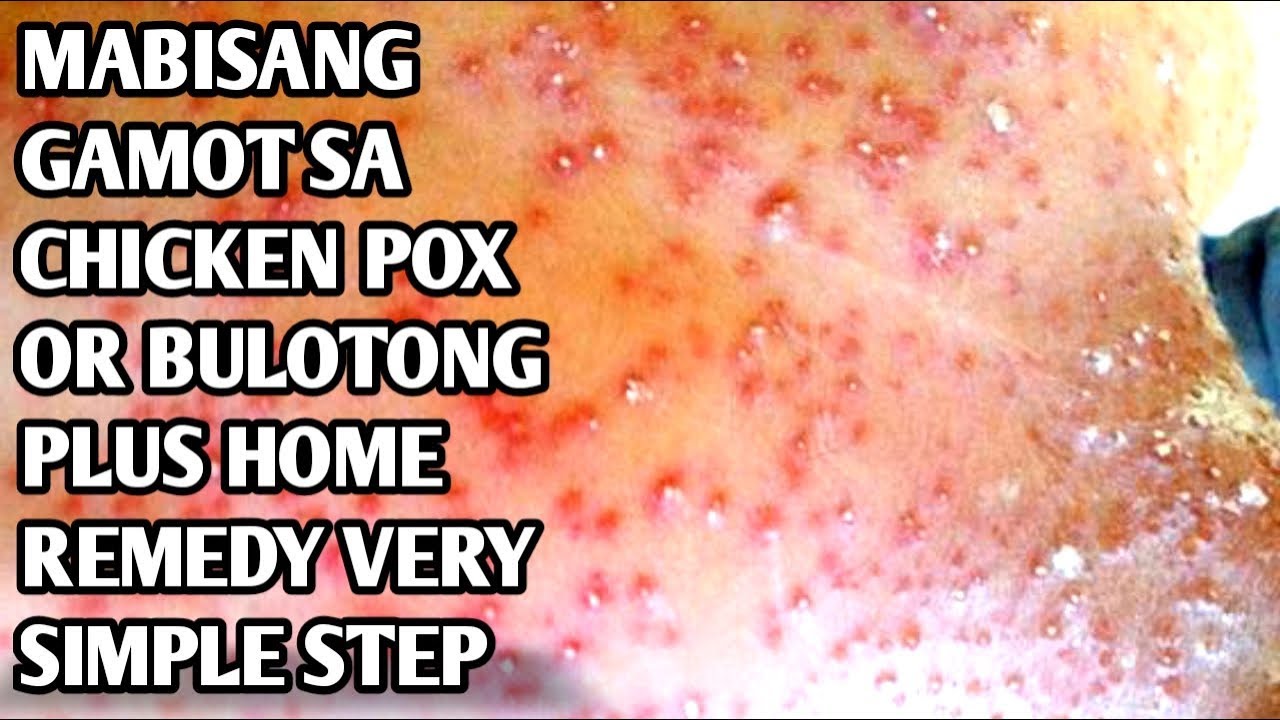 EFFECTIVE WAY TO CURE CHICKEN POX OR BULUTONG PLUS EASY HOME REMEDY+ TAMANG GAMOT