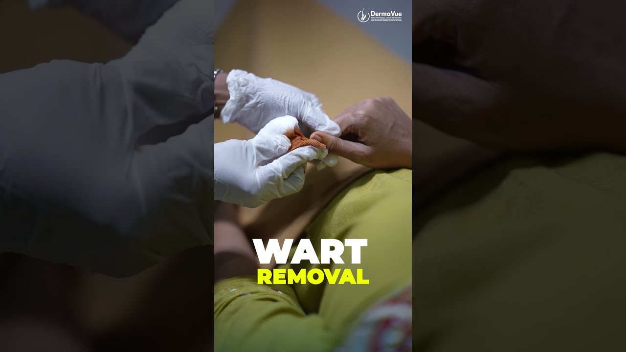 Bleomycin Injection for Recalcitrant Warts: Wart Removal Treatment that's Viral Now @DermaVue