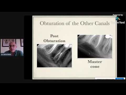 Removal Of Separated Instrument in Endodontics