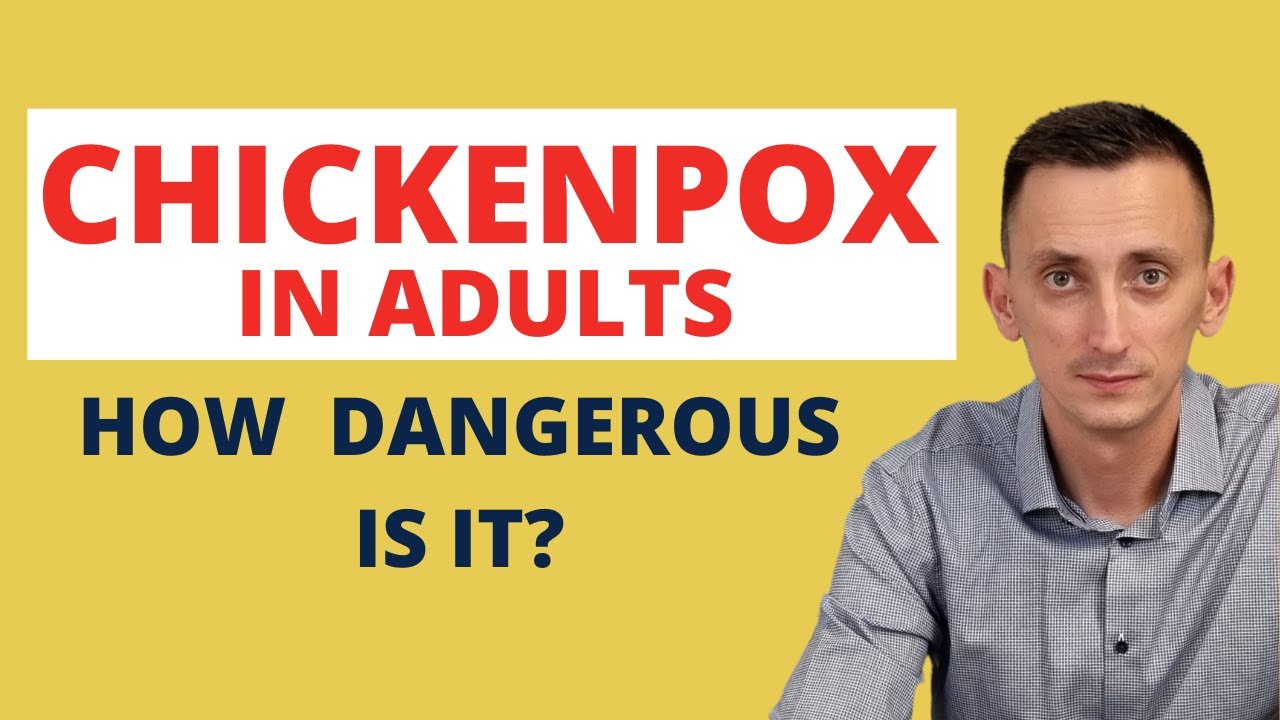 Chickenpox in Adults