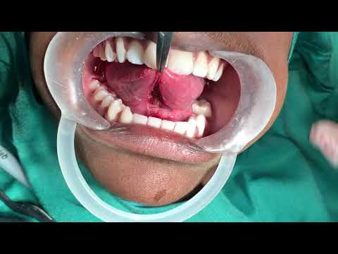 Ankyloglossia - Tongue Tie