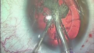 ✅ Operación de Presbicia con Lentes Intraoculares - Oftalvist