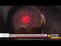 How To Prevent And Treat Migraine Attacks