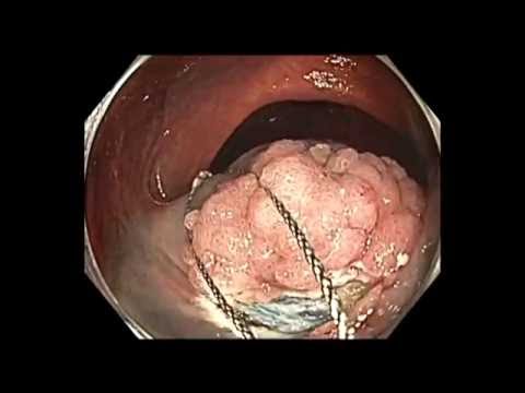 Colonoscopy: Ascending Colon Polyp - Large Polyp Resection