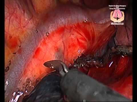 VATS Thoracoscopic Segmentectomy For Giant Bulla