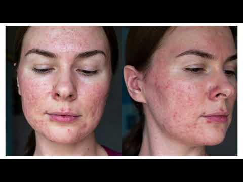 Acne Rosacea Subtypes Explained | Dermatology Guide