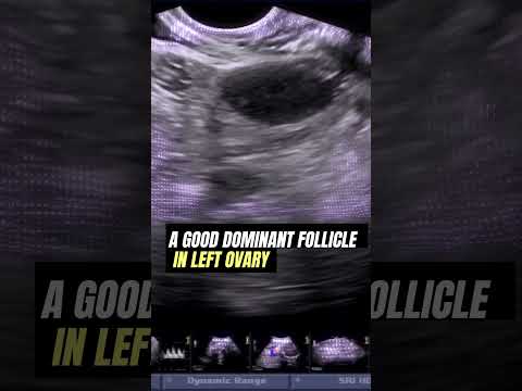 Dominant Ovarian Follicle   #Ultrasound #pregnancy #infertility #ovulation