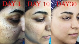 How I Got Rid of Dark Scars, Hyperpigmentation, Pimples/Acne
