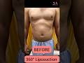 360° Liposuction Surgery Before After | Instant Amazing Results of Liposuction | Shobhit Aesthetics