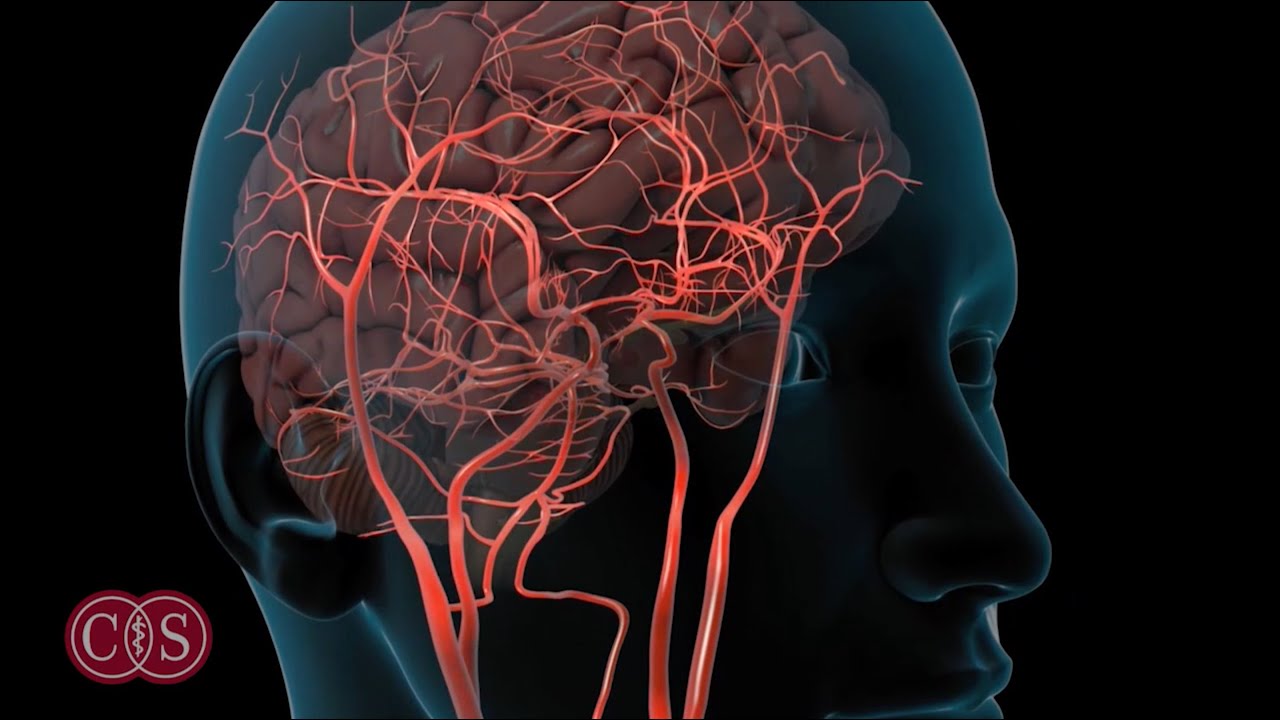 Symptoms of Stroke and Migraine | Cedars-Sinai