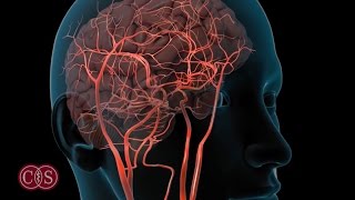 Symptoms of Stroke and Migraine | Cedars-Sinai