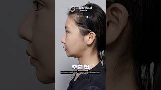 뼈 안 깎고 턱선 찾는 법? 대거상+이중턱근육묶기 리얼 후기