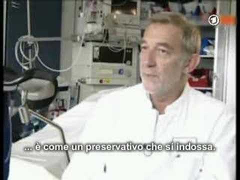 Rimozione di calcoli nella prostata Ekaterinburg Infiammazione della prostata per il trattamento