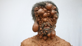 Dad’s Entire Body Is Covered In Tumours