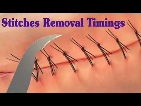 IV Cannula Colour And Size Cannula Types And Uses