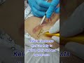 Exploring Keloid Scars A Secure Path At Dr Shaista Lodhi S Clinic KeloidScars