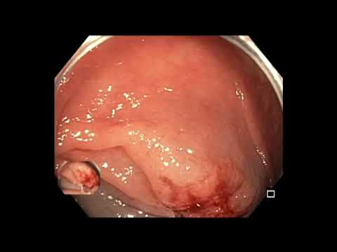 Coloscopie: LST-NG du côlon descendant - EMR