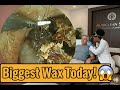 Massive Earwax Block Removed Instant Relief