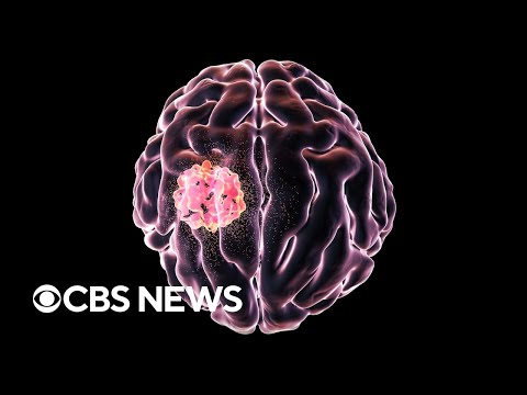 What is the aggressive brain cancer glioblastoma?