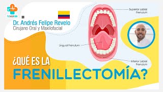 ¿Qué es la Frenillectomía | Tu Salud Guía