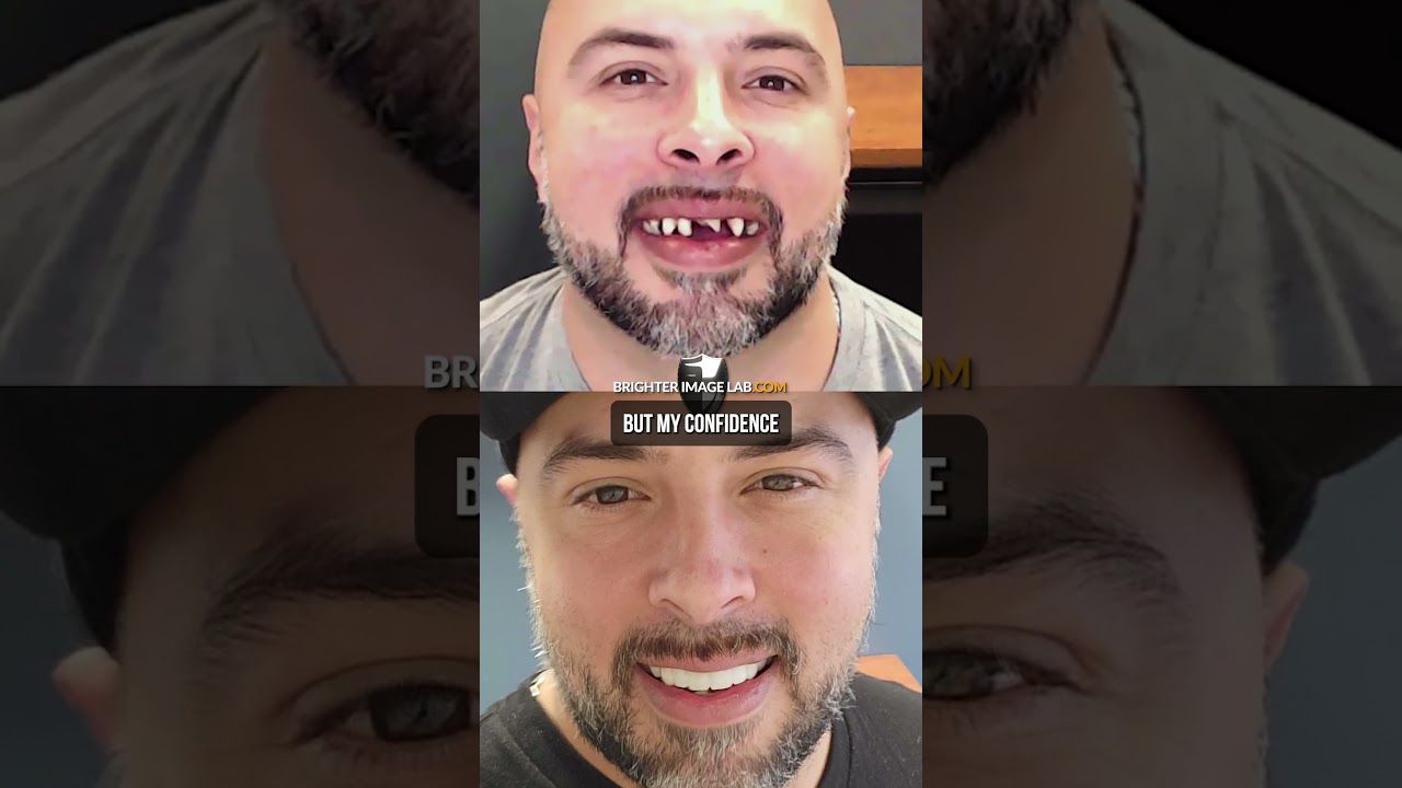 How Snap-on Veneers Changed My Confidence Forever!