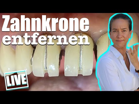 ZAHNKRONEN entfernen? Ablauf