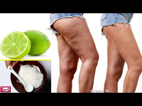 , title : 'How To Remove Cellulite Naturally with lemon juice - Remove of Cellulite fast & Varicose veins'